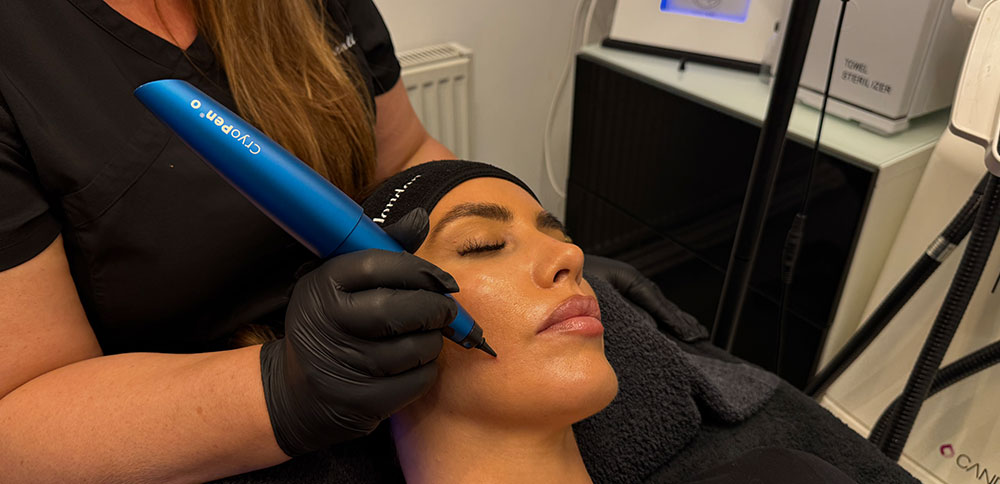 CryoPen Treatment