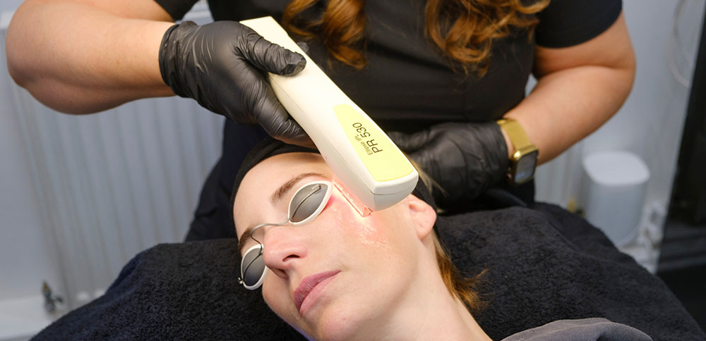 IPL Pigmentation/Vein Removal